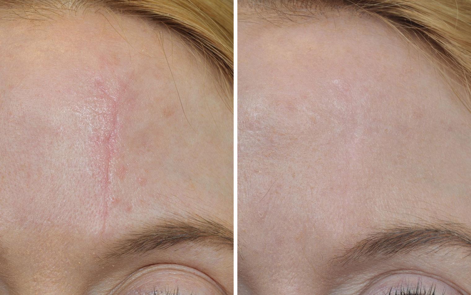 Laser Scar Removal Before And After Pictures At Mariam Sanchez Blog