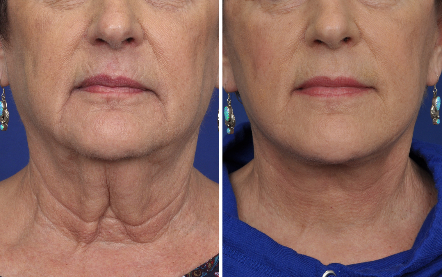 contour-dermatology-mini-facelift-before-and-after