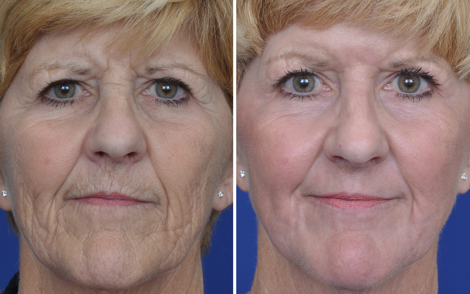 Laser Skin Resurfacing Before And After Annapolis Plastic Surgery