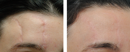 Scar Removal Annapolis MD | Scar Revision Severna Park