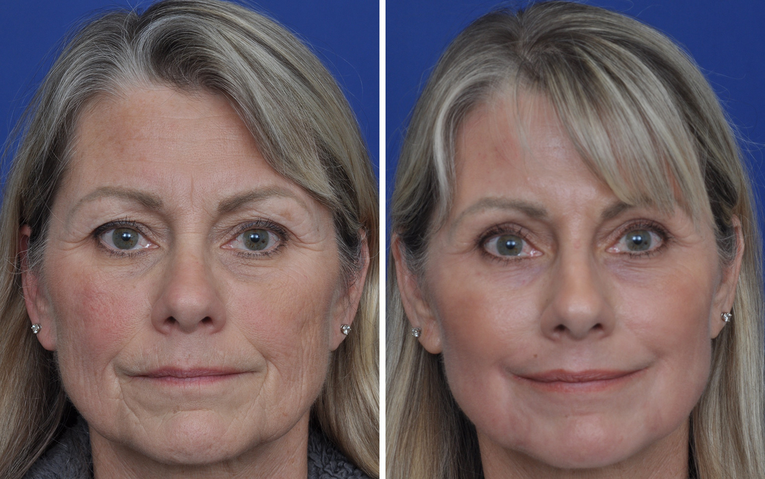 upper eyelid surgery before and after